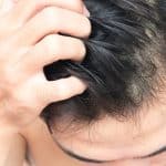 Male Pattern Baldness in Your 20s