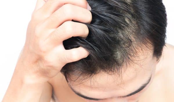 Male Pattern Baldness in Your 20s