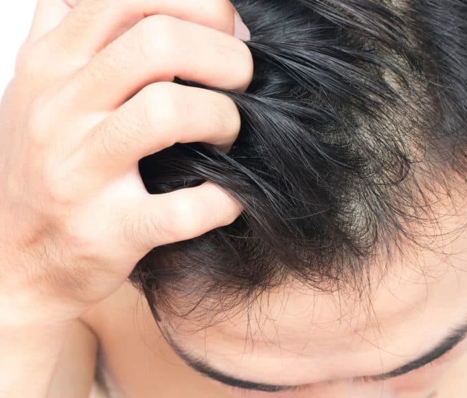 Male Pattern Baldness in Your 20s