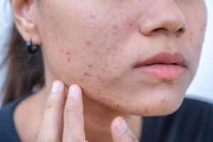 adult acne