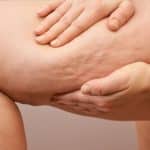 Cellulite Treatments